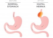 Hérnia do hiato, o que é?