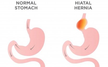 Hérnia do hiato, o que é?