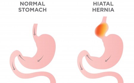 Hérnia do hiato, o que é?