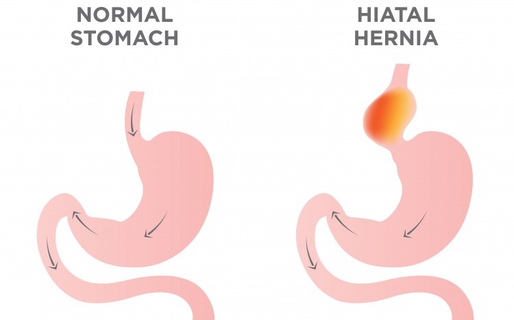 Hérnia do hiato, o que é?